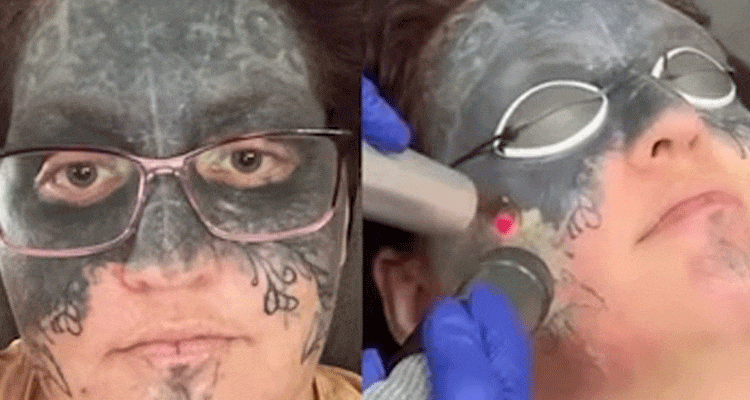 Taylor Face Tattoo Removal: Why White Face is Trending? Check Here!